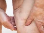 Sarcopenia